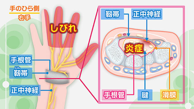手根管症候群の画像
